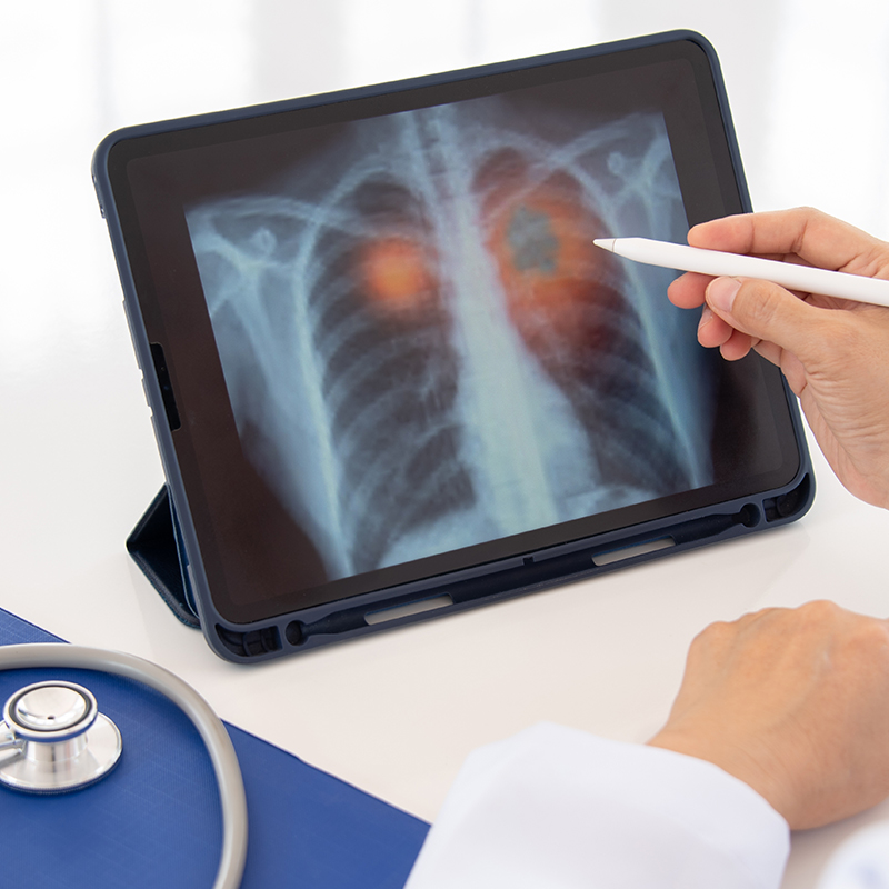 Low Dose CT Scan for Lung Cancer Screening