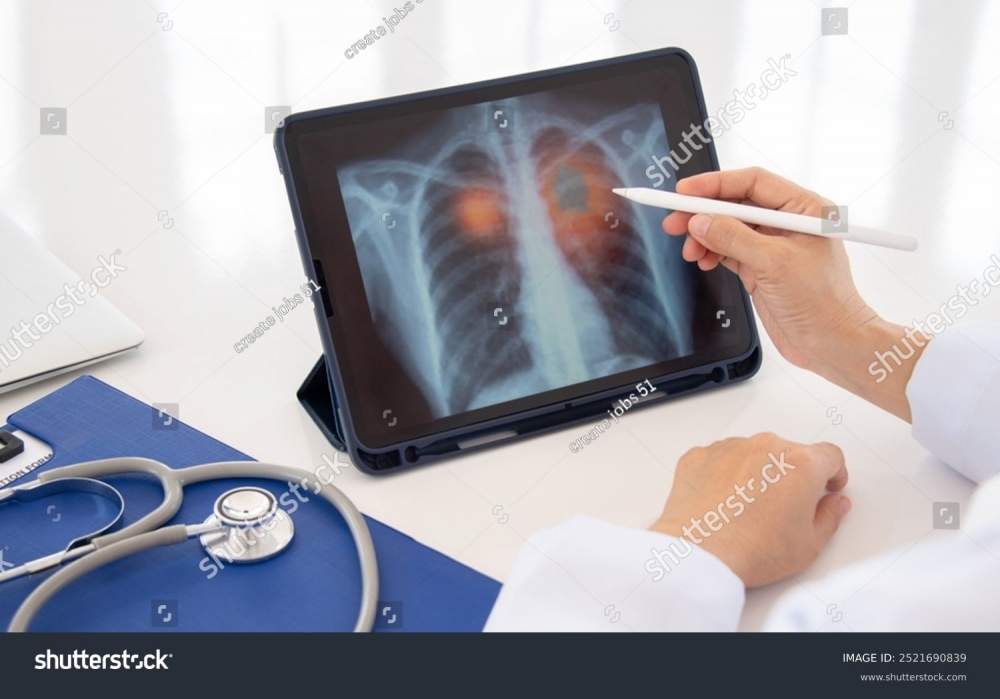 Low Dose CT Scan for Lung Cancer Screening